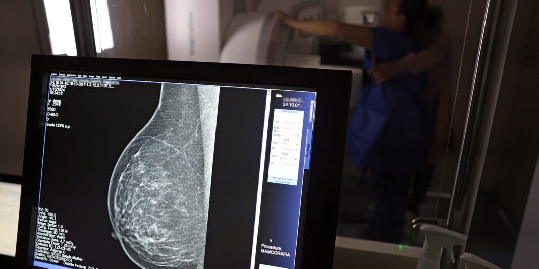 Plano de saúde deve cobrir mamografia digital para todas as faixas etárias