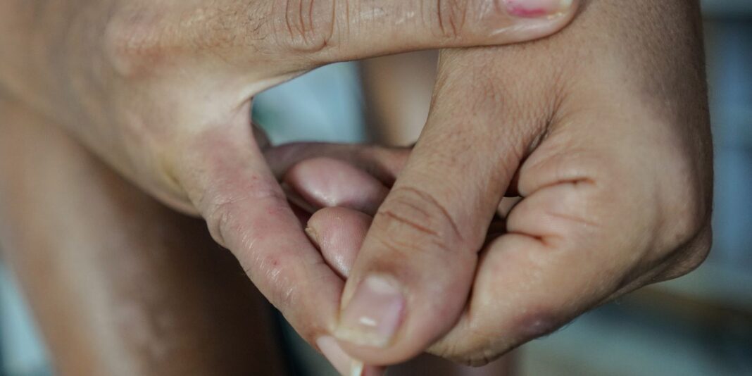 Dermatite atópica afeta pele, sono e autoestima; entenda as opções de tratamento