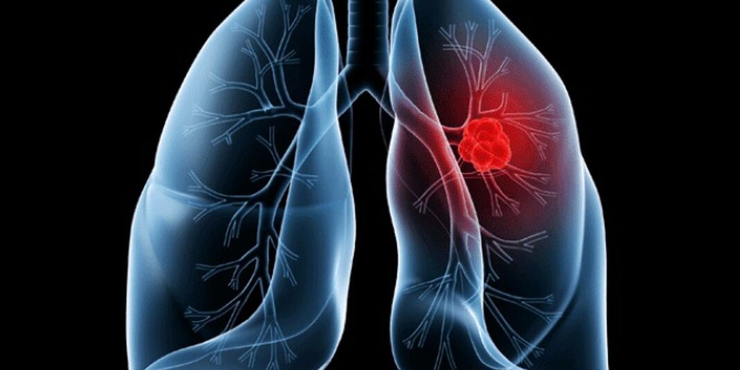 Entenda o adenocarcinoma pulmonar, câncer que afeta o Papa